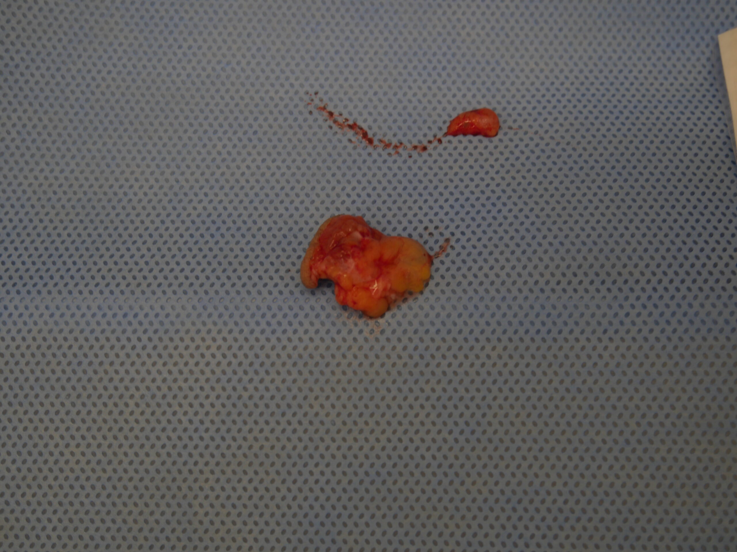 デリケートゾーンの粉瘤 腫瘍