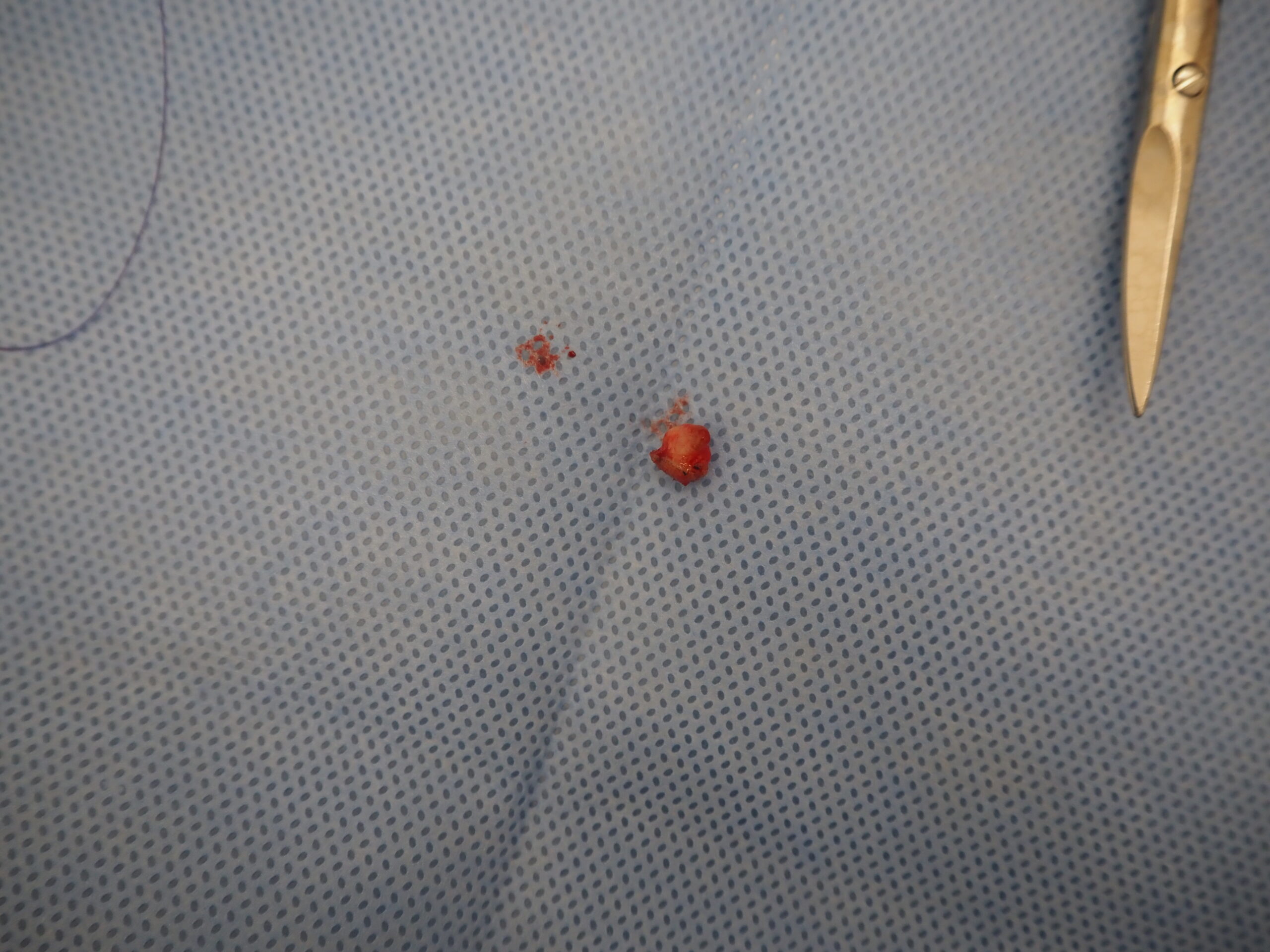 耳の粉瘤 腫瘍