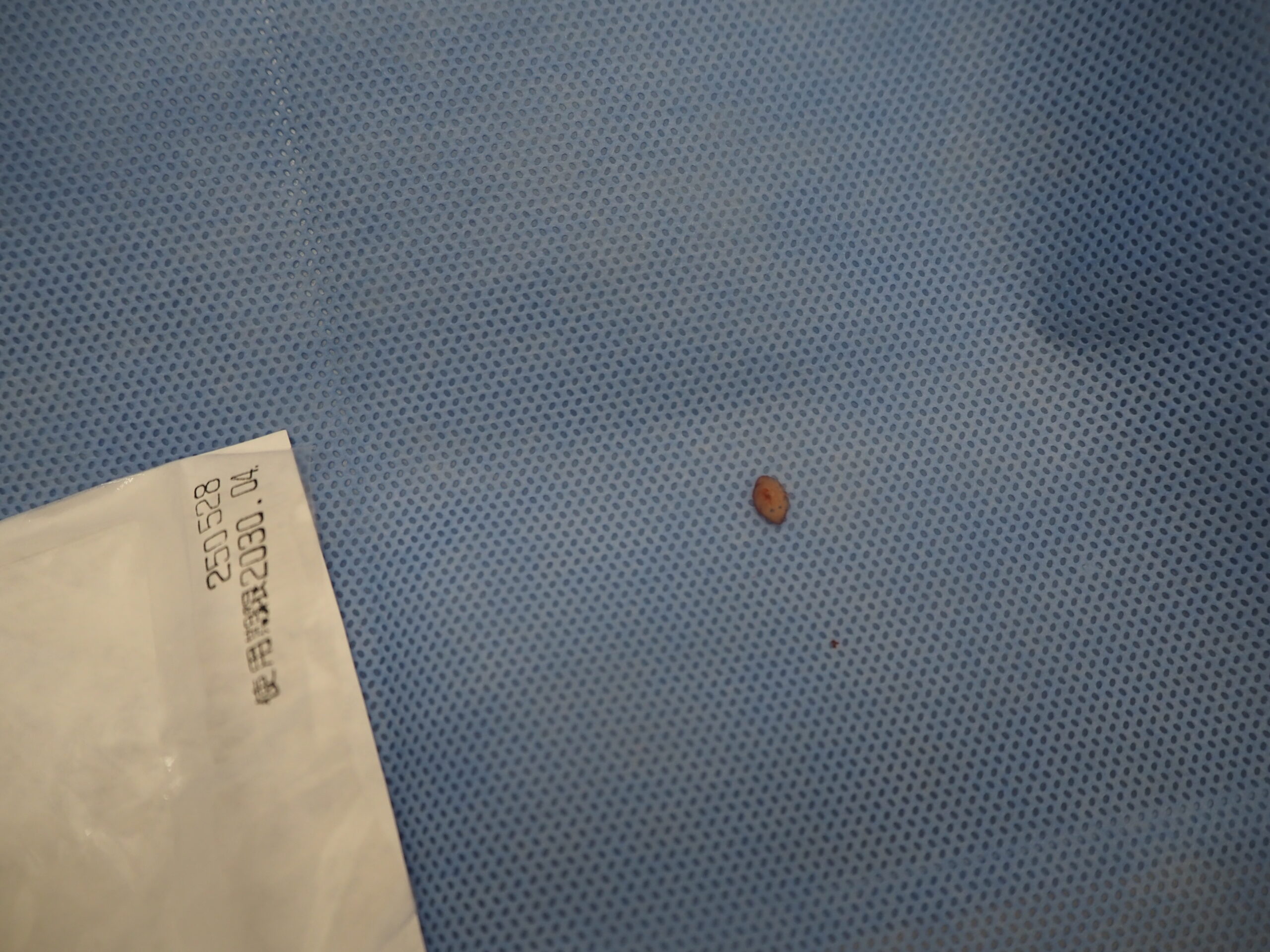 手の粉瘤 腫瘍